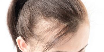 علاج لتساقط الشعر