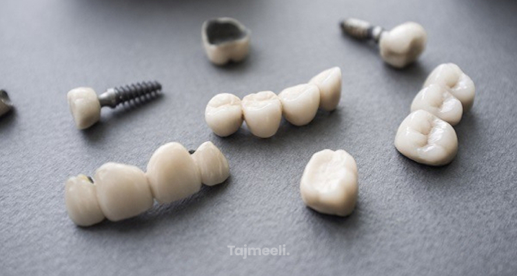 عملية تثبيت الاسنان