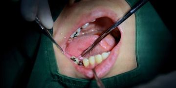 عوامل اختيار أفضل مكان لزراعة الأسنان