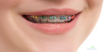 كيف تختار أفضل الوان التقويم للأسنان؟