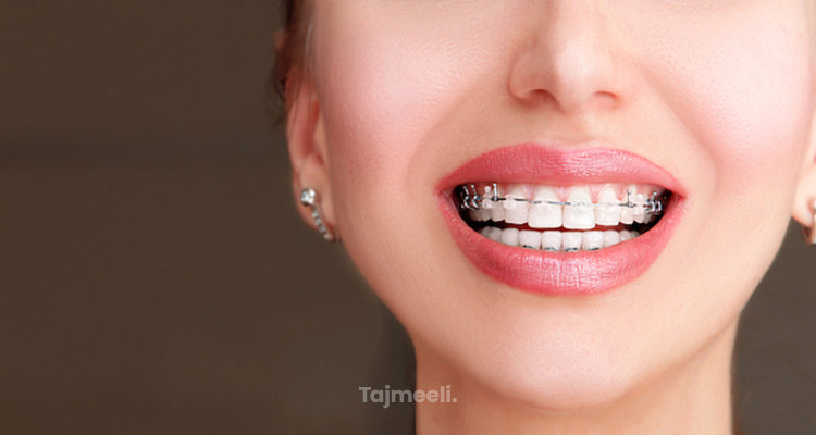 ما هي مدة تقويم الاسنان لأسنان جميلة بدون فراغات