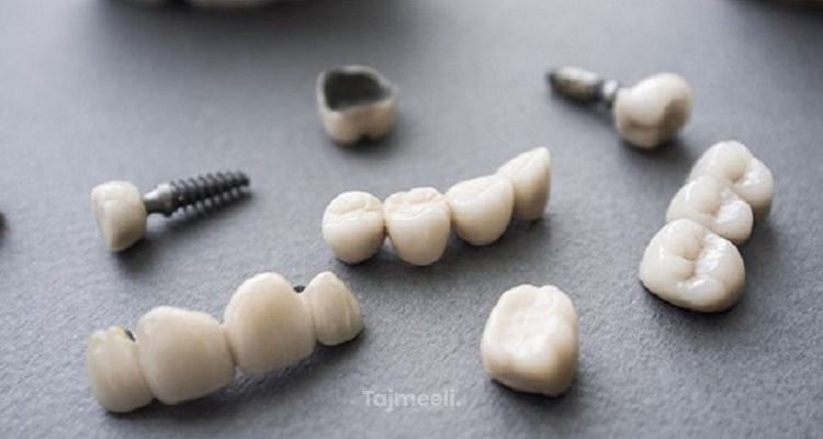 ما هي مراحل زراعة الأسنان ؟