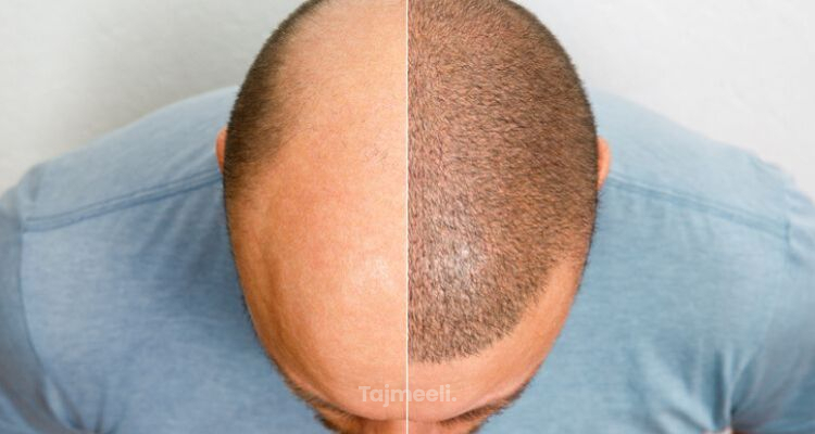 متى تثبت البصيلات بعد زراعة الشعر