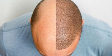 متى تثبت البصيلات بعد زراعة الشعر