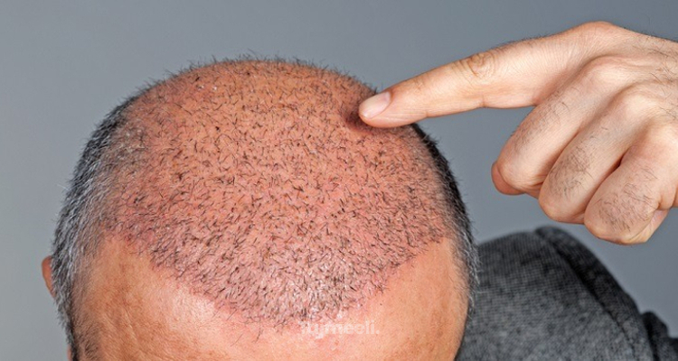 متى تظهر نتيجة عملية زراعة الشعر ؟