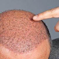 متى تظهر نتيجة عملية زراعة الشعر ؟