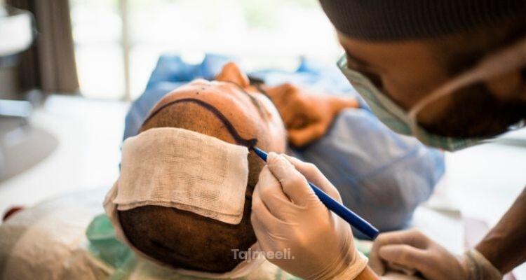 متى تظهر نتيجة عملية زراعة الشعر ؟