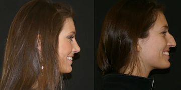 مراحل تغير الأنف بعد عملية التجميل