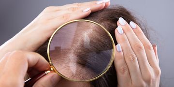هل يمكن احياء بصيلات الشعر الميتة؟