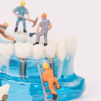 كم تدوم زراعة الاسنان ؟ هل زراعة الاسنان دائمة ام تفشل الزرعات مع الوقت