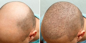 طرق زراعة الشعر. ما هي طريقة التخدير المستخدمة في زراعة الشعر وهل هناك ألم في زراعة الشعر؟