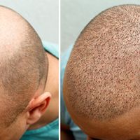طرق زراعة الشعر. ما هي طريقة التخدير المستخدمة في زراعة الشعر وهل هناك ألم في زراعة الشعر؟