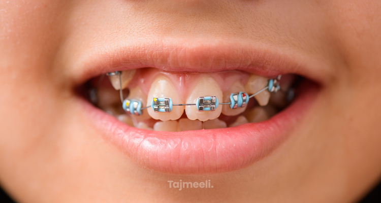 دليل شامل حول تقويم أسنان الأطفال
