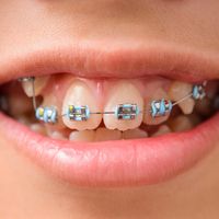 دليل شامل حول تقويم أسنان الأطفال