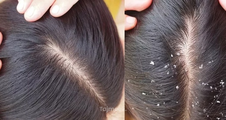 الفرق بين صدفية الشعر والقشرة: الأسباب والأعراض وطرق العلاج