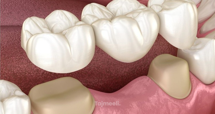 أسباب سقوط جسر الأسنان وكيفية الحفاظ عليه