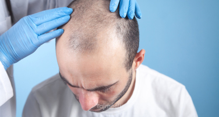 زراعة الشعر في الصيف أم الشتاء؟ تعرف على المميزات والعيوب