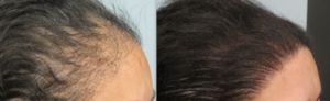 نتائج زراعة الشعر بالصور