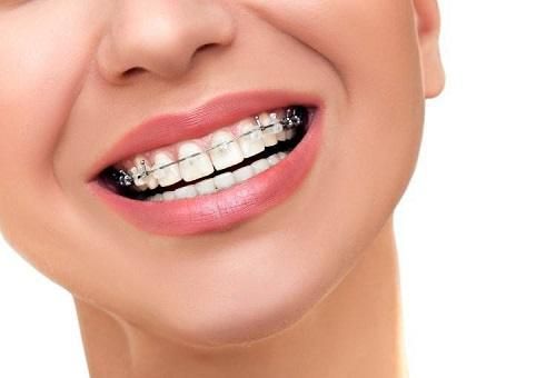 ما الإجراءات الأخرى التي يمكن أن ينصح بها الطبيب بعد إزالة تقويم الأسنان Dental braces؟