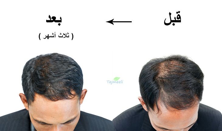قبل وبعد زراعة الشعر الطبيعي