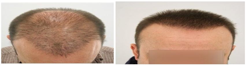 نتائج وصور قبل وبعد زراعة الشعر الطبيعي
