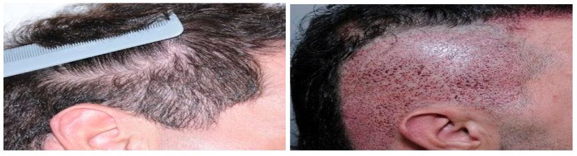 نتائج وصور قبل وبعد زراعة الشعر الطبيعي١