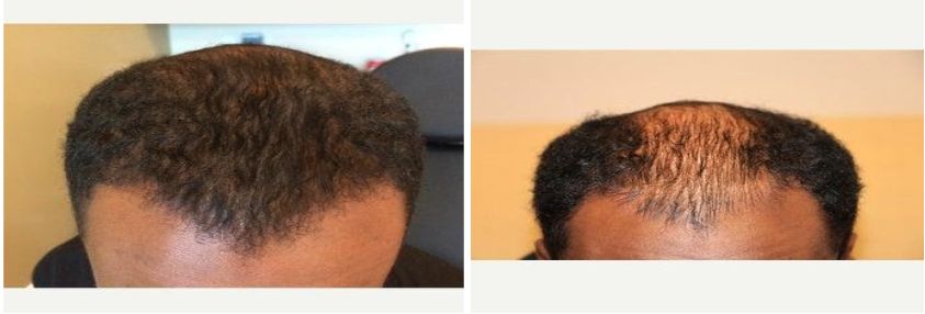 نتائج وصور قبل وبعد زراعة الشعر الطبيعي٥