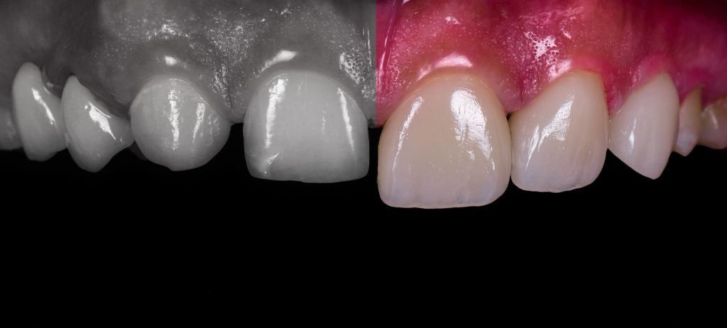 عدم تناسق ألوان أسنان الزيركون مع الأسنان الطبيعية