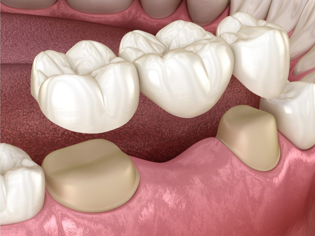 ما هو جسر الاسنان وكيف يتم تركيبه؟