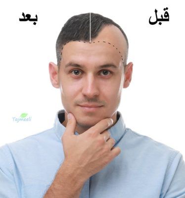 افضل مراكز زراعة الشعر فى مصر