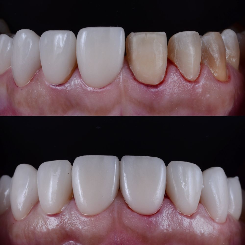 نتائج برد الاسنان قبل وبعد