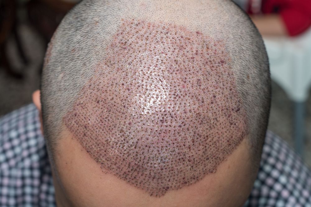 About Egypt and hair transplant