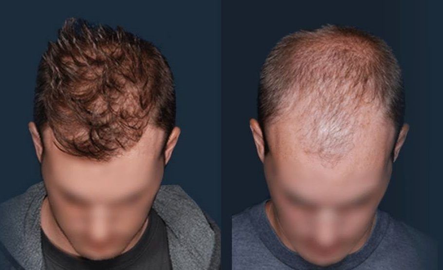 Advantages of Hair Transplant Procedures in Egypt
