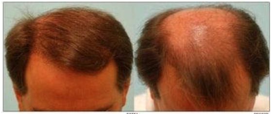 زراعة الشعر في تاج الرأس