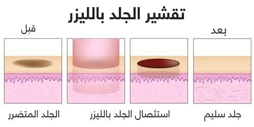 علاج الجلد بالفراكشنال ليزر