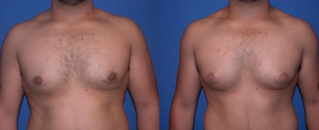 ⁨‎⁨جراحة إزالة أنسجة الثدي لعلاج التثدي عند الرجال⁩⁩