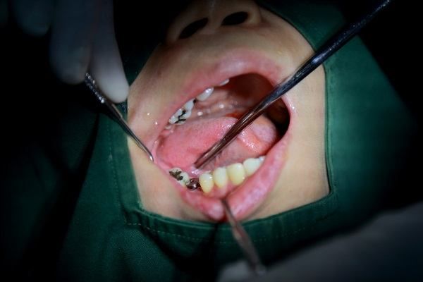 من هم المرشحون لجراحة الأسنان التجميلية ؟
