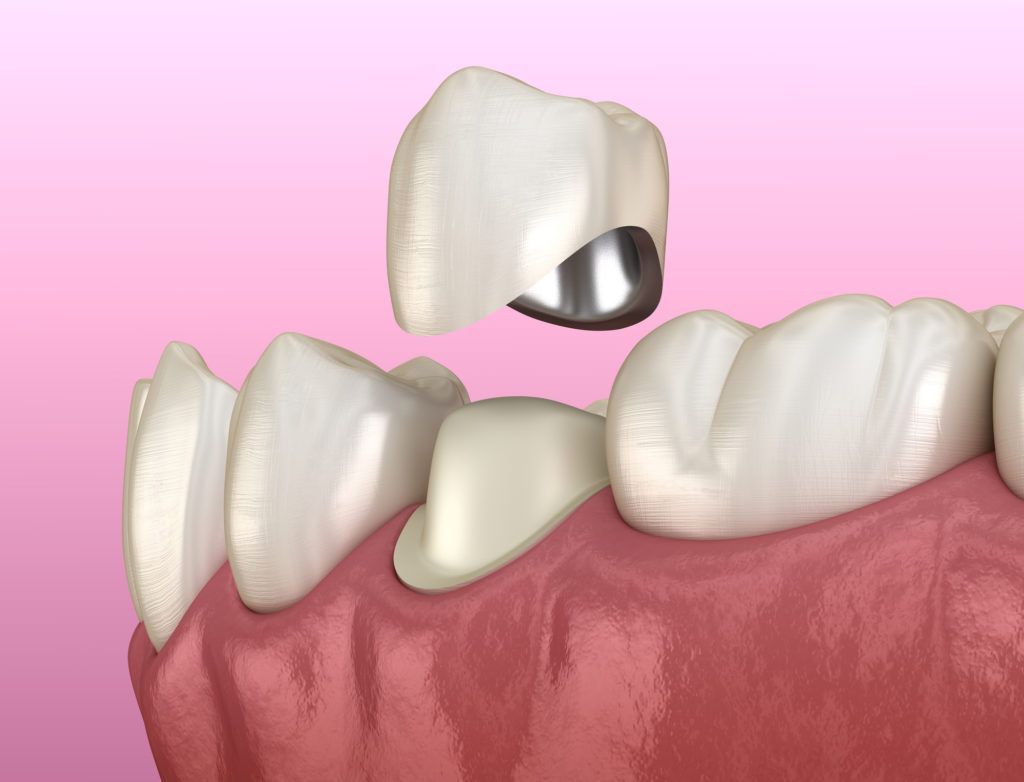 أنواع تركيبات الأسنان - تيجان الأسنان