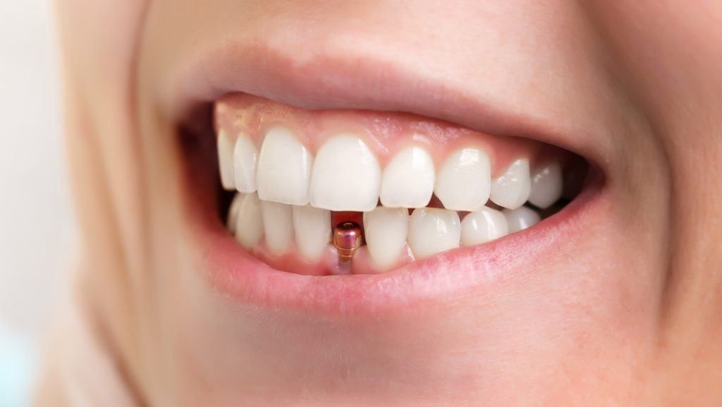 وسائل الحصول على تركيبات الأسنان الثابتة