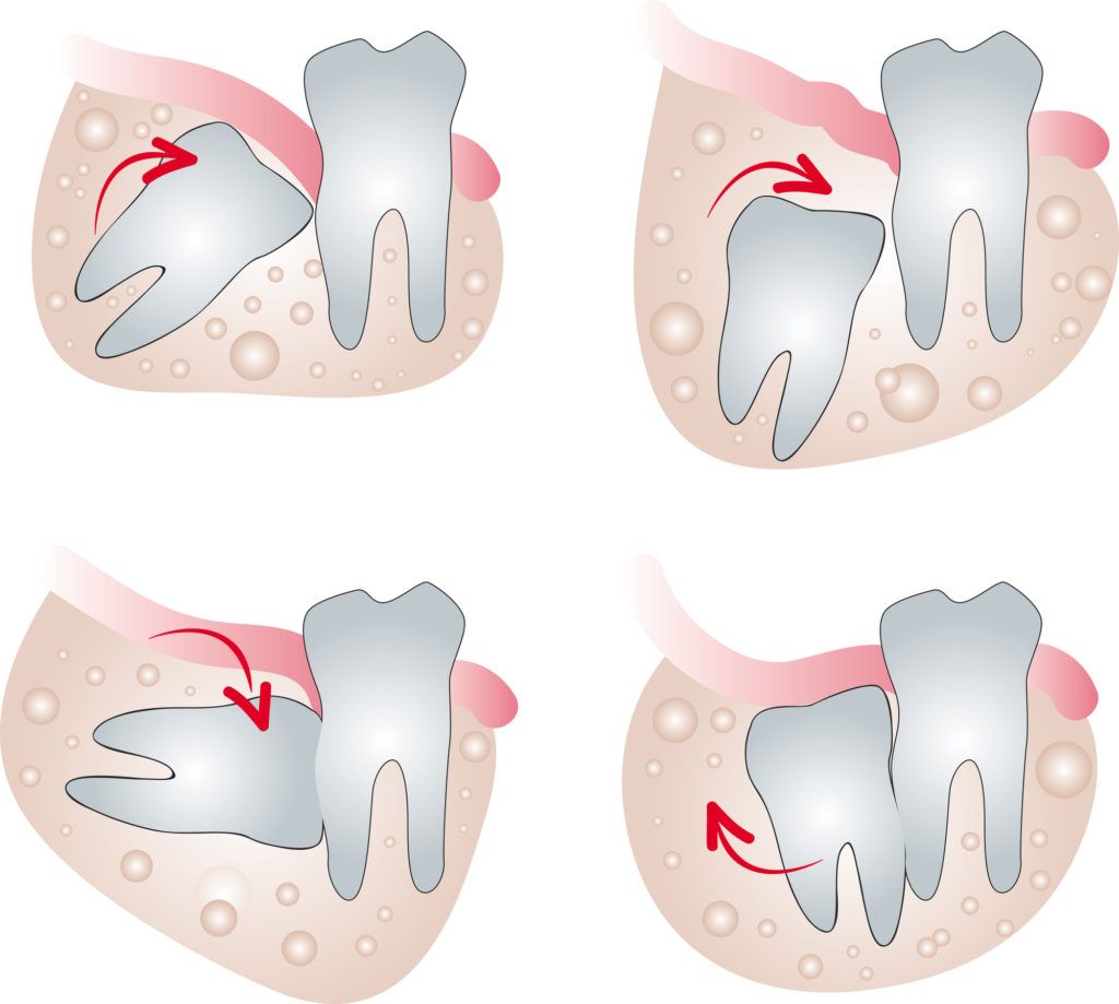 علاج انتفاخ اللثة فوق الضرس المُنحشر (Impacted tooth)