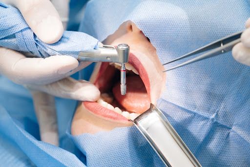 About Dental Implants in the UAE