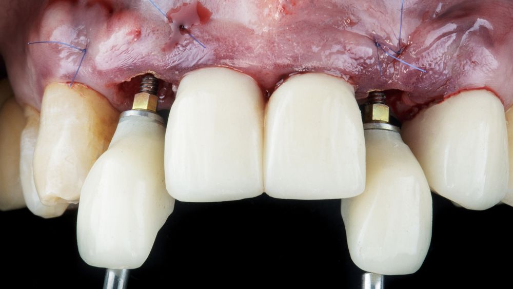 Dental Implants in Abu Dhabi