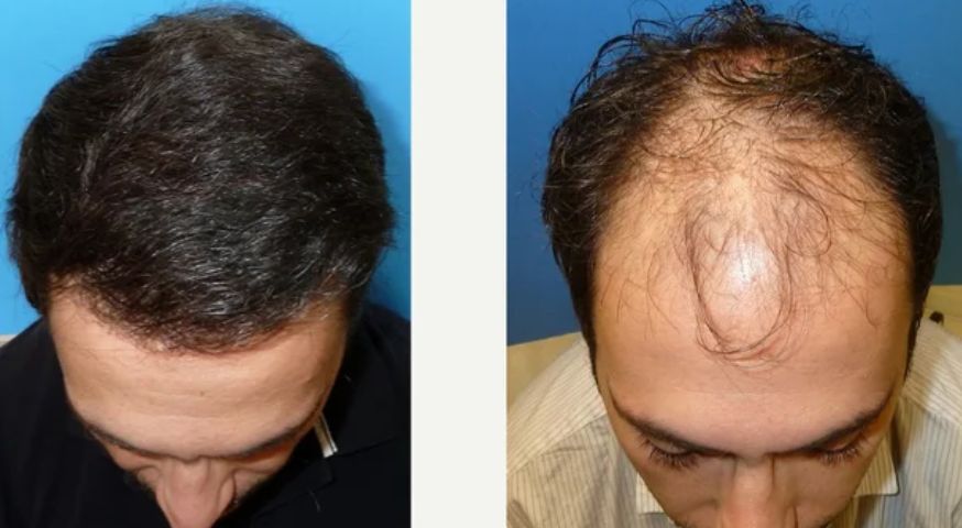 تجربة طبيب أجرى عملية زراعة الشعر