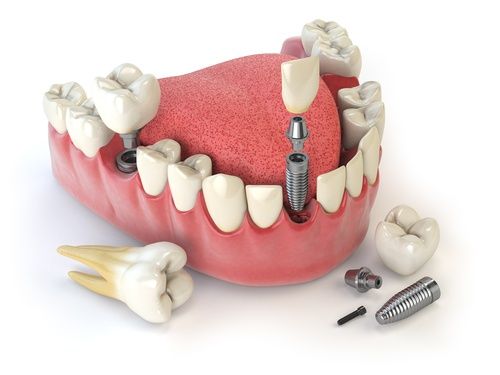 عمليات زراعة الأسنان