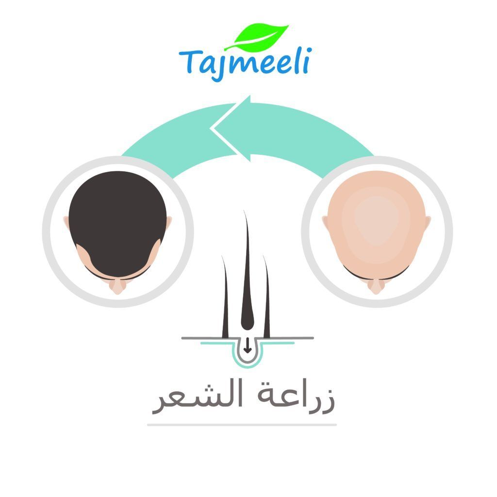 عملية زراعة الشعر في تونس
