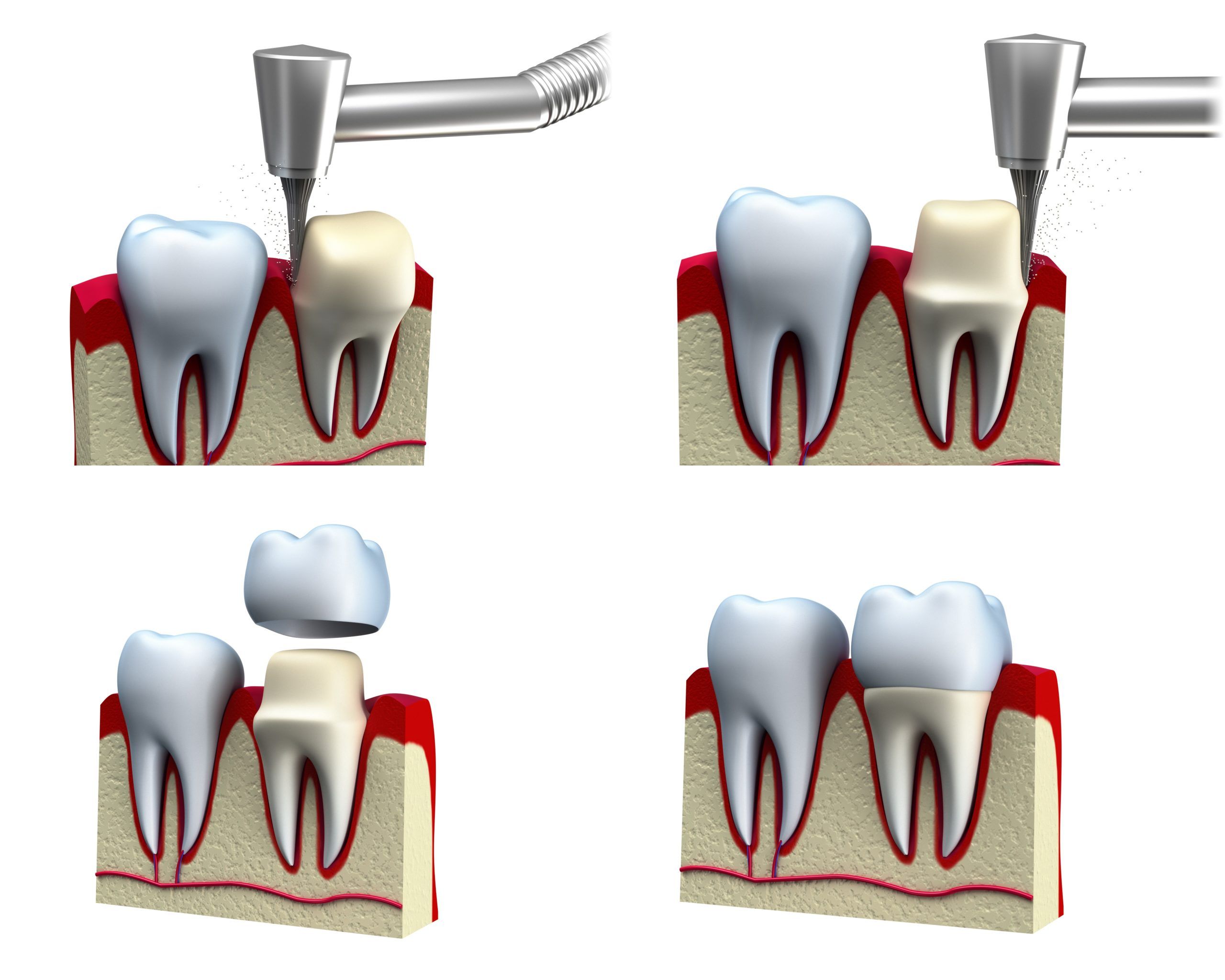 ماهي تركيبات الاسنان