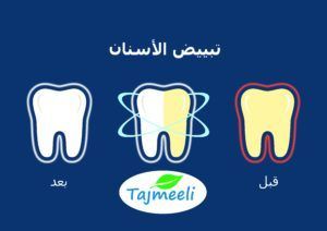 أنواع تبييض الأسنان واسعارها