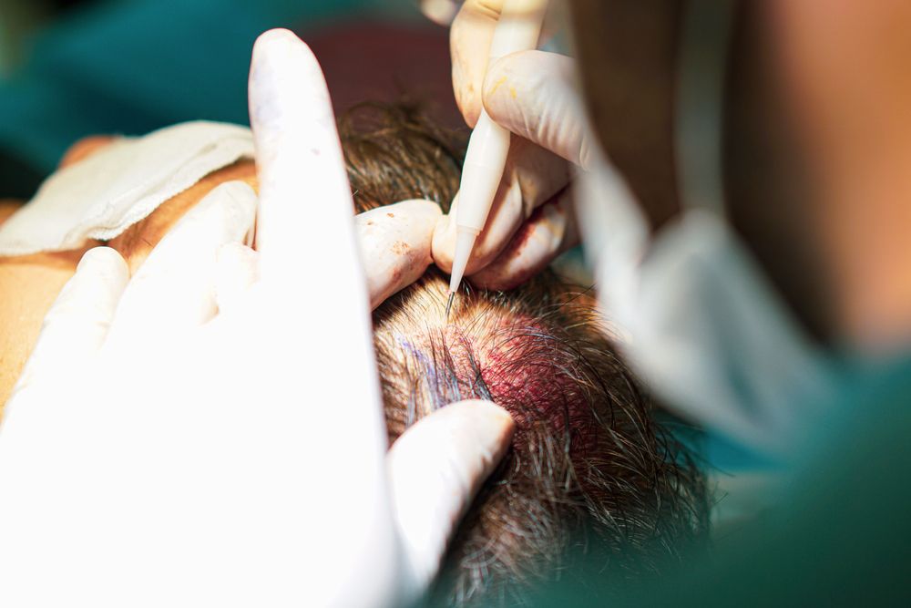 The best hair transplant doctors in Saudi Arabia