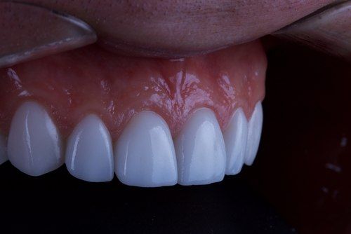 معالجةالاسنان باستخدام اللومينير