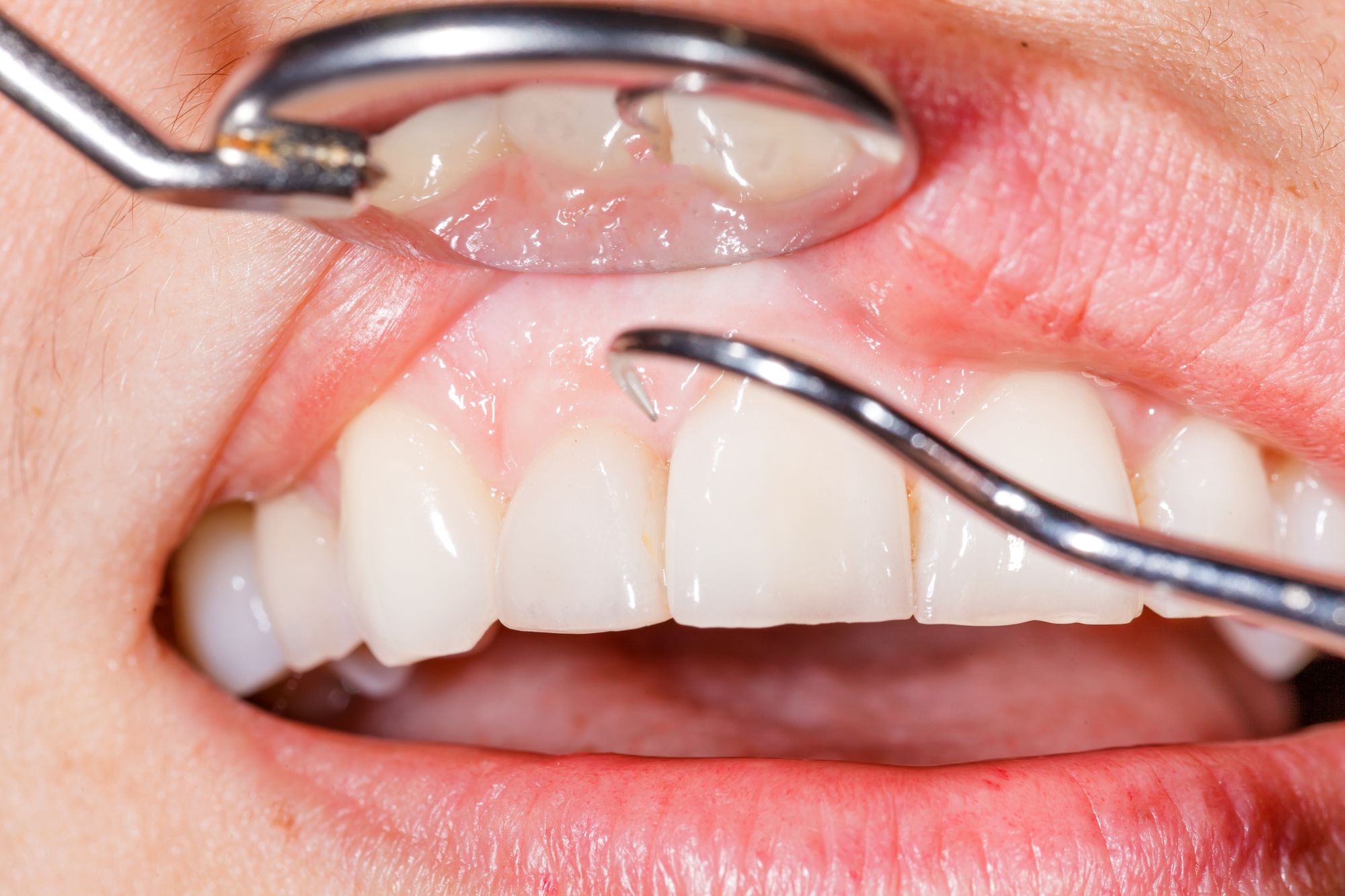 أسباب نزول اللثة بين الأسنان